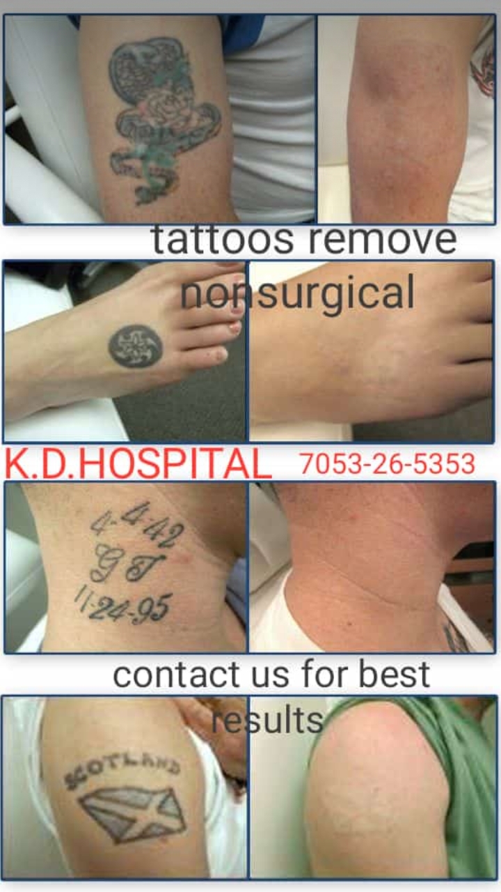 Laser Tattoo Removal in Morpeth — Aspen Hair, Beauty & Laser Hair Removal
